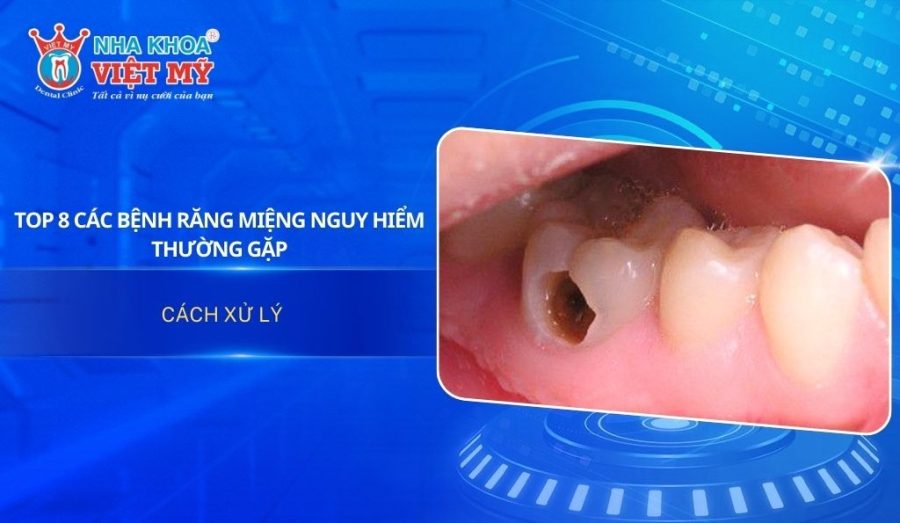 TOP 8 các bệnh răng miệng nguy hiểm thường gặp & cách xử lý