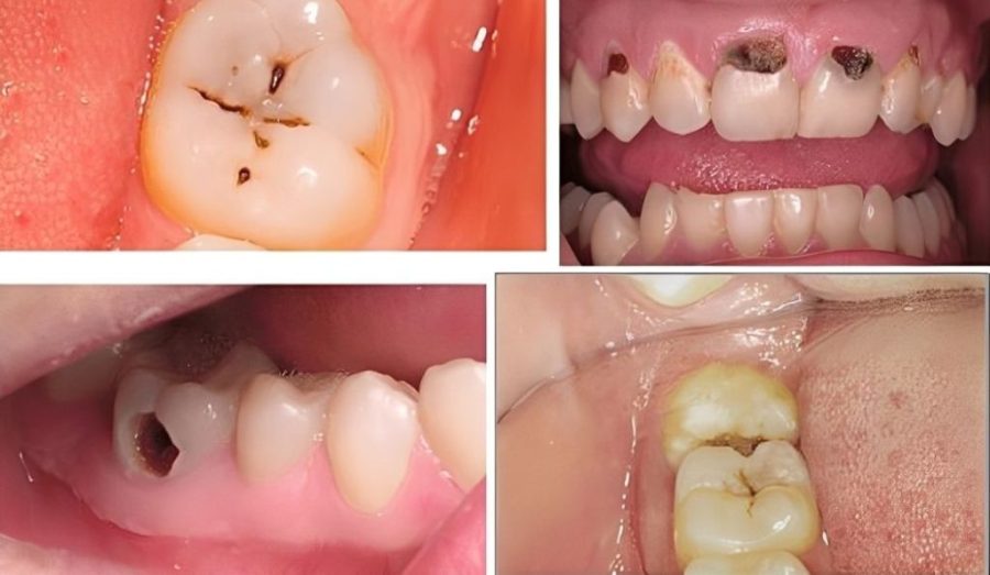 Trám răng có bị sâu lại không?