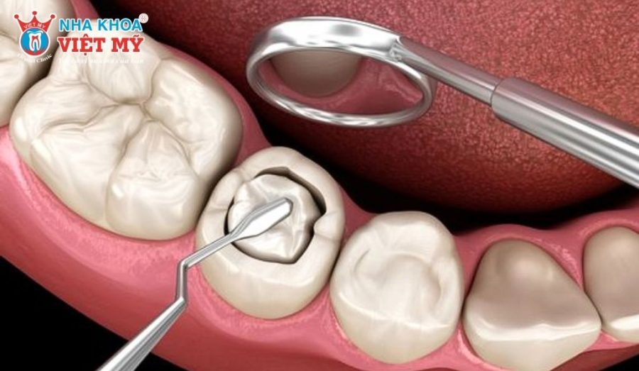 Chi phí trám răng bao nhiêu tiền có phụ thuộc vào vật liệu trám răng