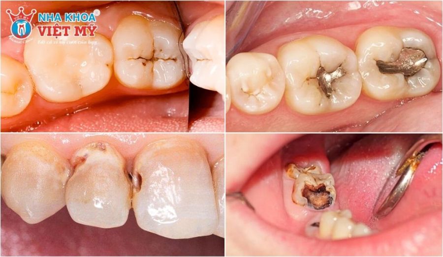 Răng sâu sẽ điều trị tùy theo trường hợp khác nhau