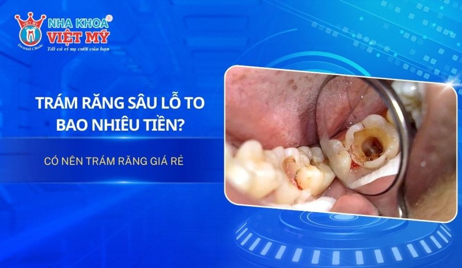 Trám răng sâu lỗ to bao nhiêu tiền? Có nên trám răng giá rẻ