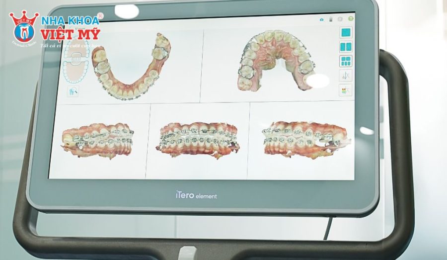 Phòng khám tại Nha khoa Việt Mỹ được trang bị iTero Element 5D đạt chuẩn