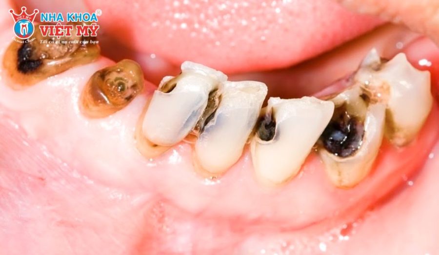 Các rủi ro khi trám răng sâu giá rẻ