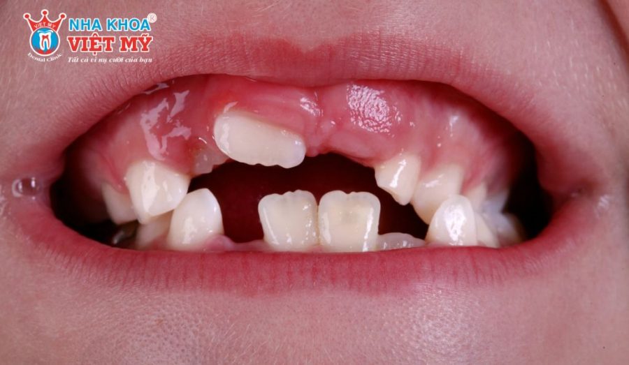 Trẻ em bị gãy răng sữa có ảnh hưởng gì?
