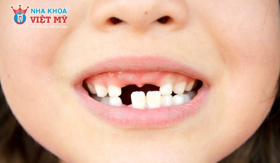 Trẻ bị gãy răng sữa có mọc lại không?