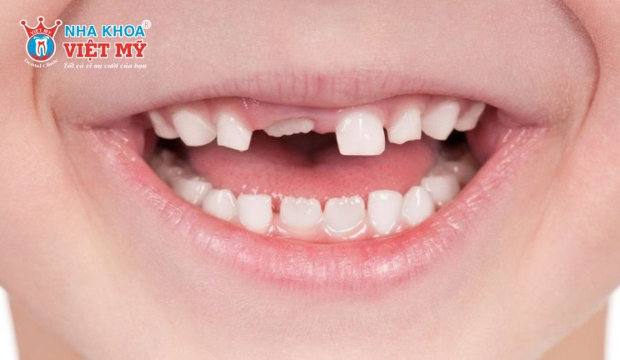 Vì sao răng sữa ở trẻ em bị gãy?