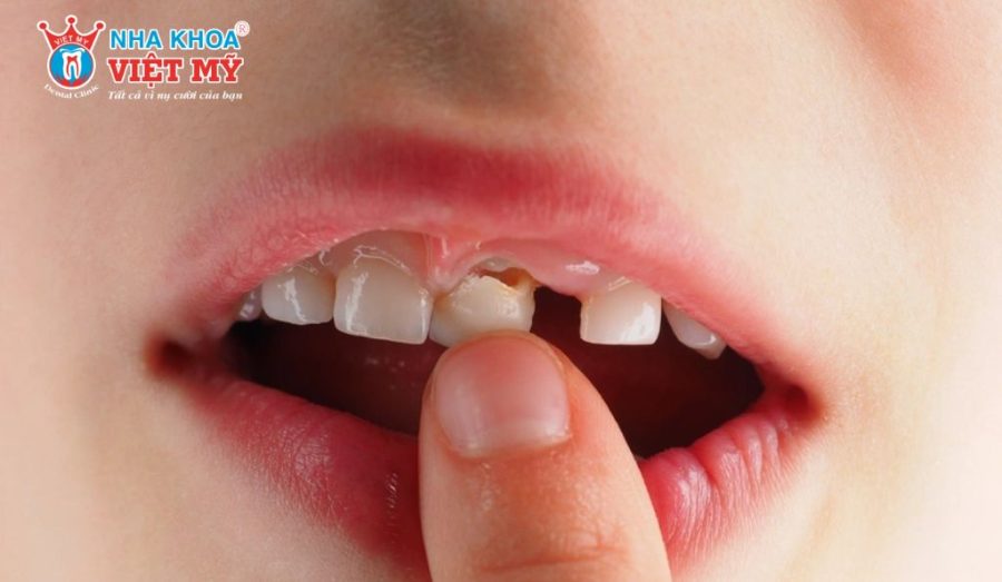 Cách phòng tránh trường hợp gãy răng sữa ở trẻ