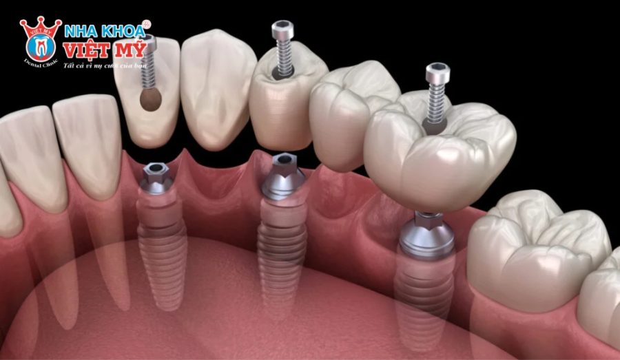 Chính sách trả góp trồng răng Implant tại Nha khoa Việt Mỹ