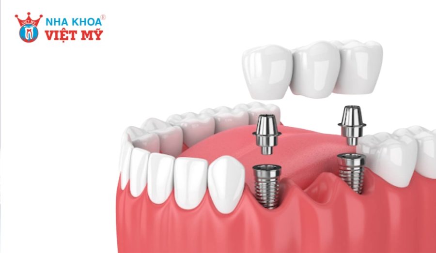 Trồng răng Implant trả góp cho phép khách hàng chia nhỏ chi phí điều trị thay vì thanh toán một lần