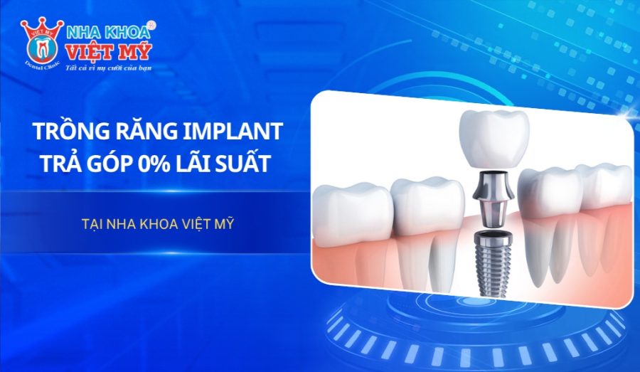 Trồng răng Implant trả góp 0% lãi suất tại Nha khoa Việt Mỹ