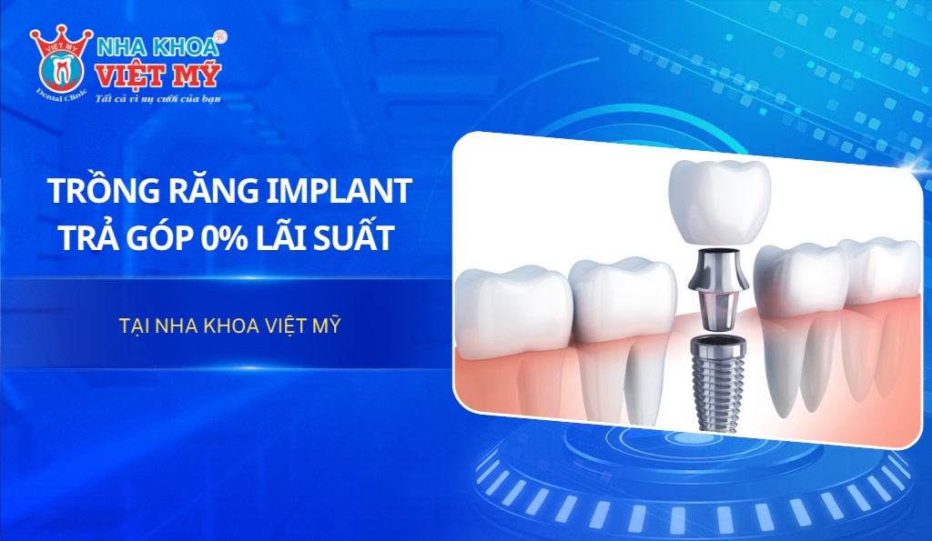 Trồng răng Implant trả góp 0% lãi suất tại Nha khoa Việt Mỹ