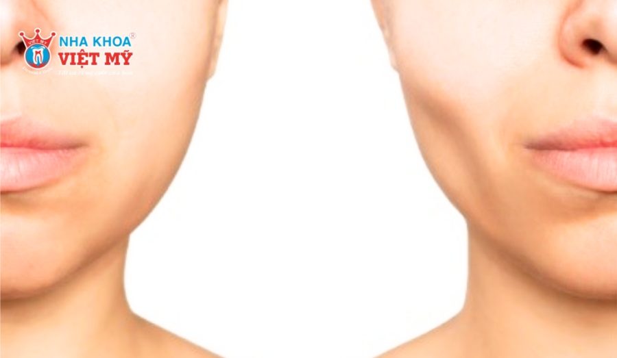 Răng số 7 bị mất khiến khuôn mặt mất cân đối