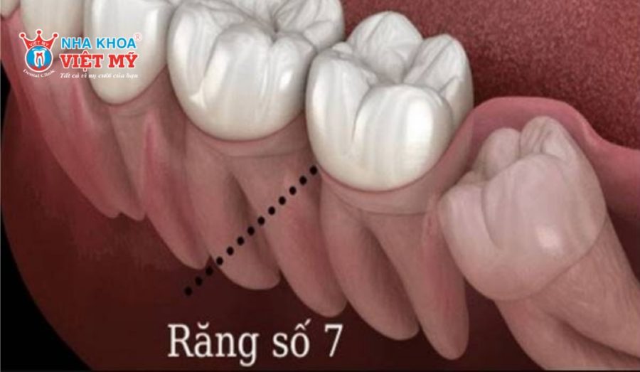Răng số 7 là răng hàm lớn thứ hai, nằm sau răng số 6 và trước răng số 8