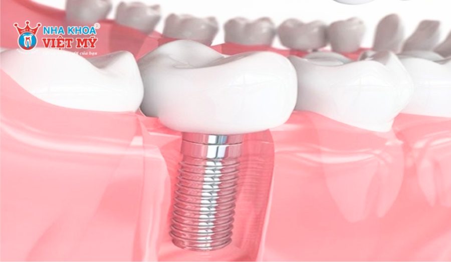 Trồng răng số 7 giá bao nhiêu phụ thuộc vào chất liệu trụ và mão sứ