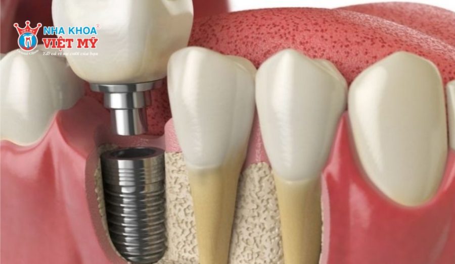 Trồng răng số 7 bằng phương pháp Implant