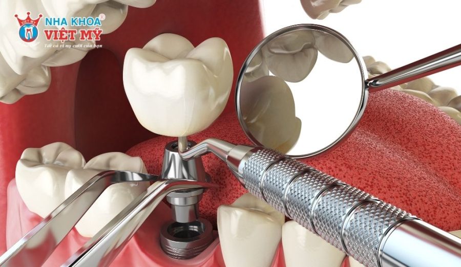 Sau 2 - 3 tháng, trụ Implant tích hợp xương ổn định sẽ gắn răng sứ hoàn chỉnh