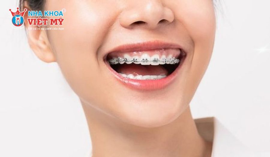 Khi cung răng có đủ không gian sẽ không cần nhổ trước khi niềng.