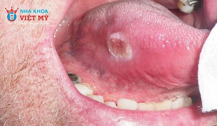 Ung thư khoang miệng có thể được chữa khỏi nếu điều trị sớm