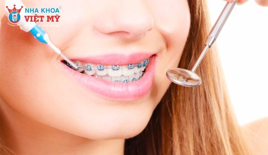 Vì sao cần làm sạch răng miệng đúng cách khi niềng răng?