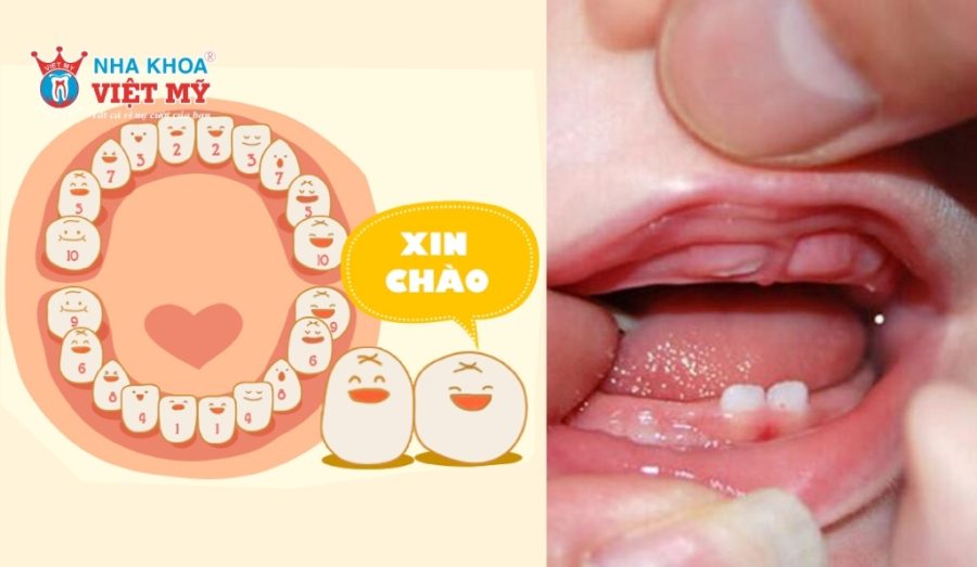Trình tự mọc răng ở trẻ