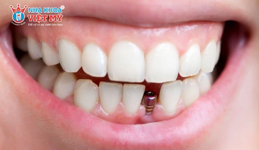 Trường hợp được cấy ghép Implant tức thì khi xương hàm ổn định và chân răng nhỏ