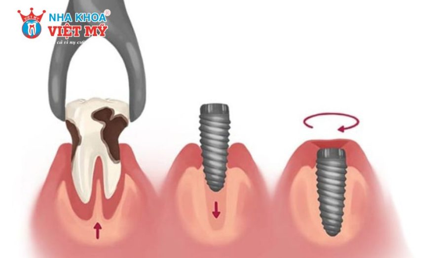 Quy trình cấy ghép Implant tức thì được thực hiện trong môi trường vô khuẩn
