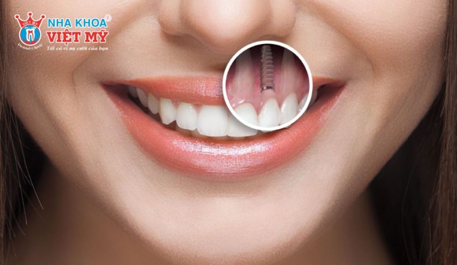 Ưu điểm của cấy ghép Implant tức thì là giảm số lần phẫu thuật và thời gian điều trị