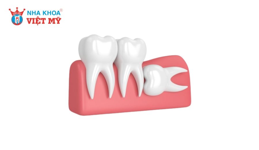 Răng khôn mọc ngang thường đâm vào răng số 7