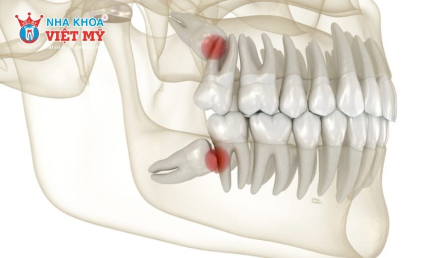 Răng khôn mọc lệch hàm trên không nhổ kịp thời dễ gây biến chứng nguy hiểm