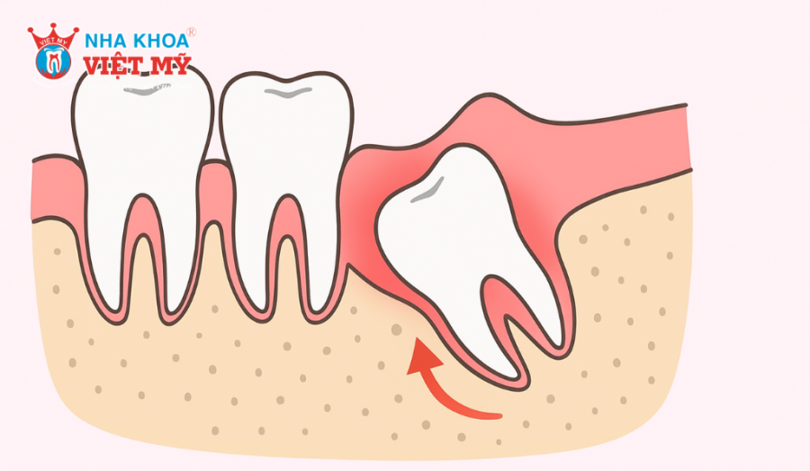 Răng khôn là răng mọc cuối cùng trên cung hàm, thường xuất hiện ở độ tuổi 17 - 25