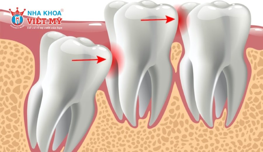 Răng khôn mọc lệch hàm trên thường được chỉ định nhổ bỏ để ngăn ngừa biến chứng