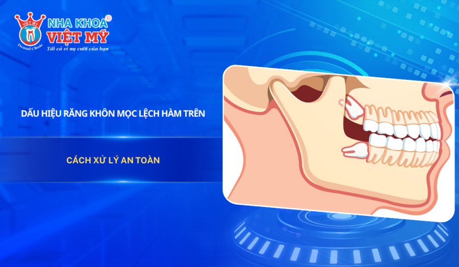 Dấu hiệu răng khôn mọc lệch hàm trên và cách xử lý an toàn