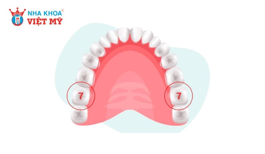 Mất răng cối mà không phục hồi kịp cũng là nguyên nhân răng khôn hàm trên mọc lệch