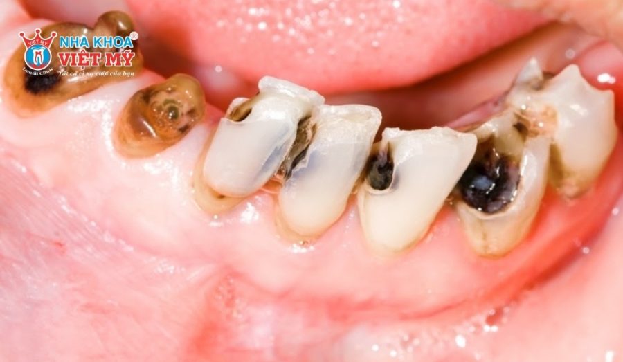 Sâu răng là tình trạng mô cứng của răng bị phá hủy dần