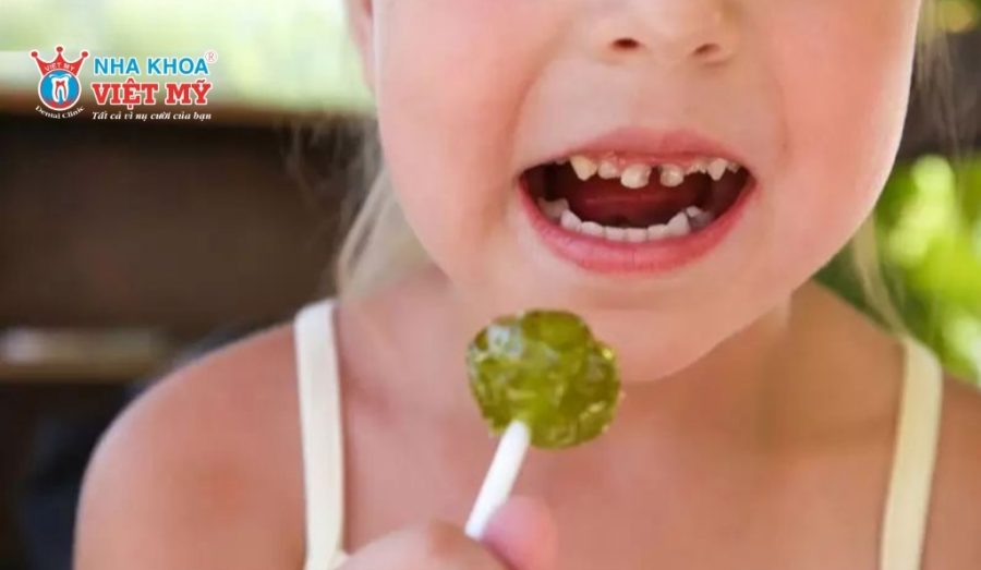 Sâu răng do vi khuẩn và thói quen ăn uống, vệ sinh sai cách