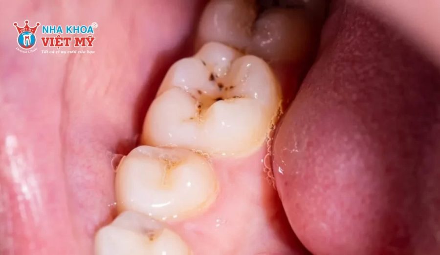 Xuất hiện lỗ sâu trên răng là dấu hiệu sâu răng rõ nhất