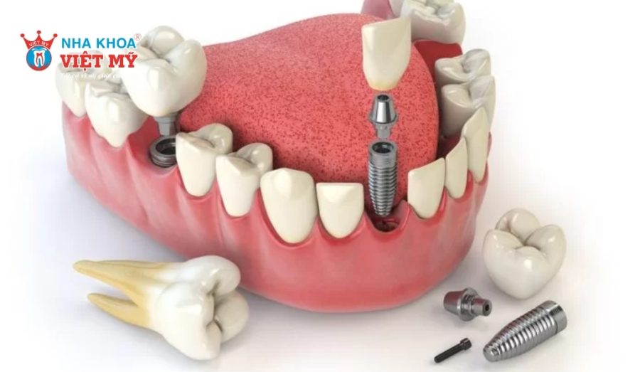 Phục hình răng bằng phương pháp Implant