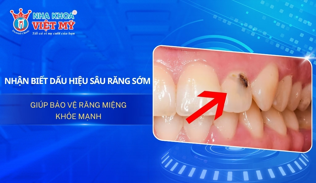 Nhận biết dấu hiệu sâu răng sớm giúp bảo vệ răng miệng khỏe mạnh