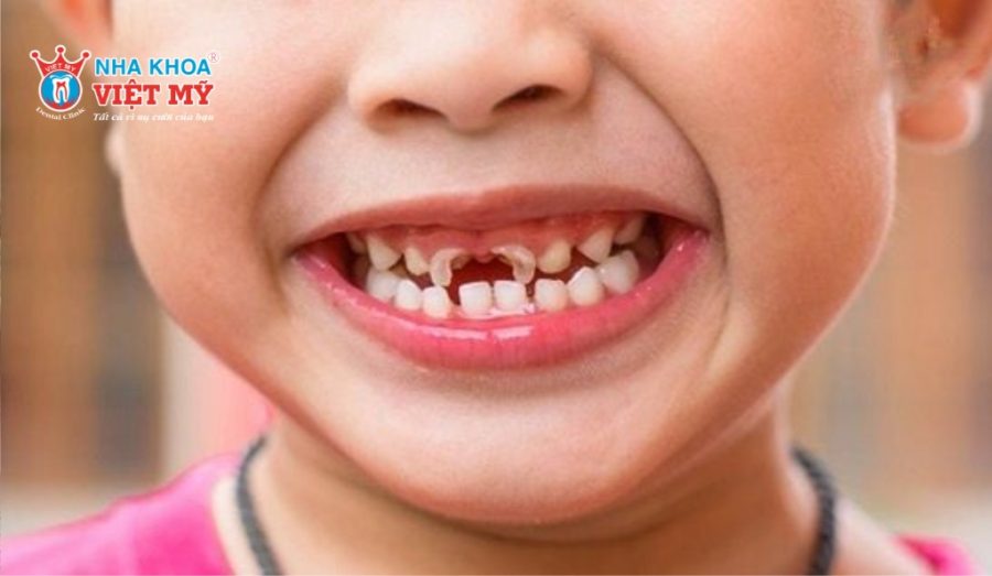 Sâu răng có thể xảy ra ở mọi lứa tuổi