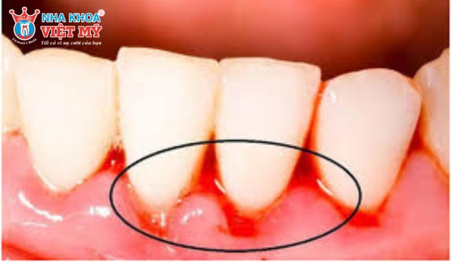 Persistent Bleeding or Severe Pain