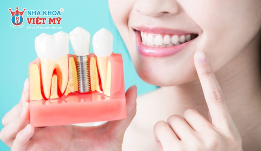 Dental Implants Aftercare - Tooth Structure Model