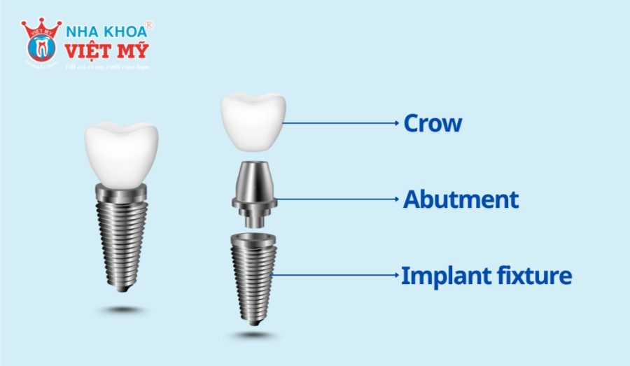 A dental implant consists of three components: implant fixture, abutment and crown
