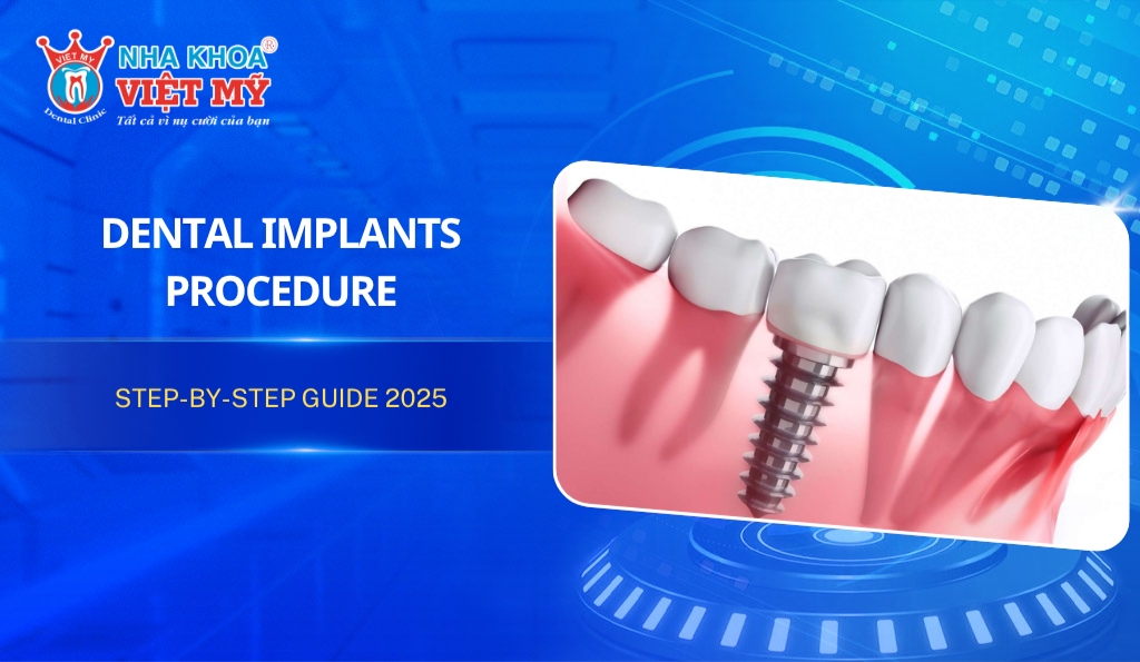 Dental Implants procedure: Step-by-step guide 2025