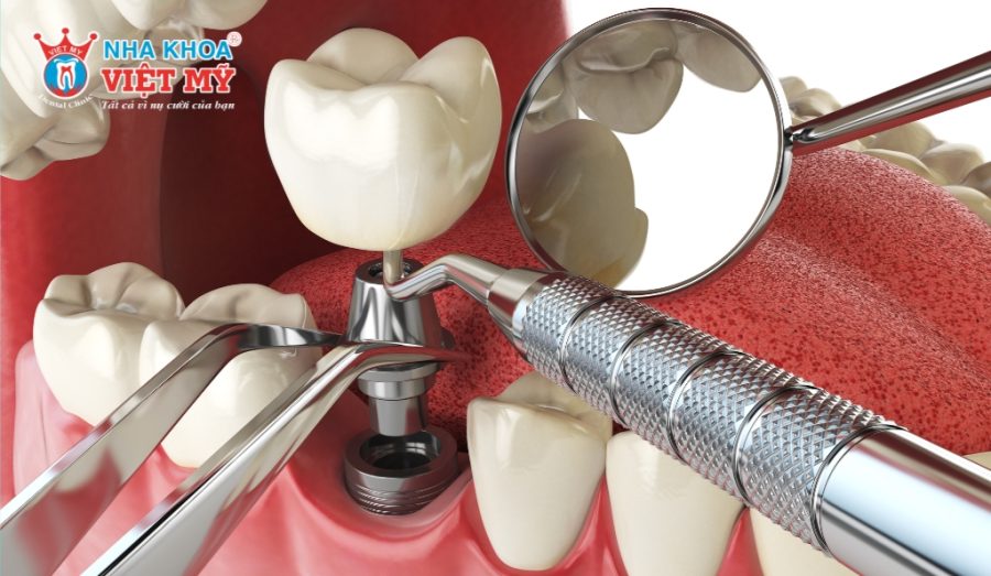 The duration of the dental implant procedure depends on several factors