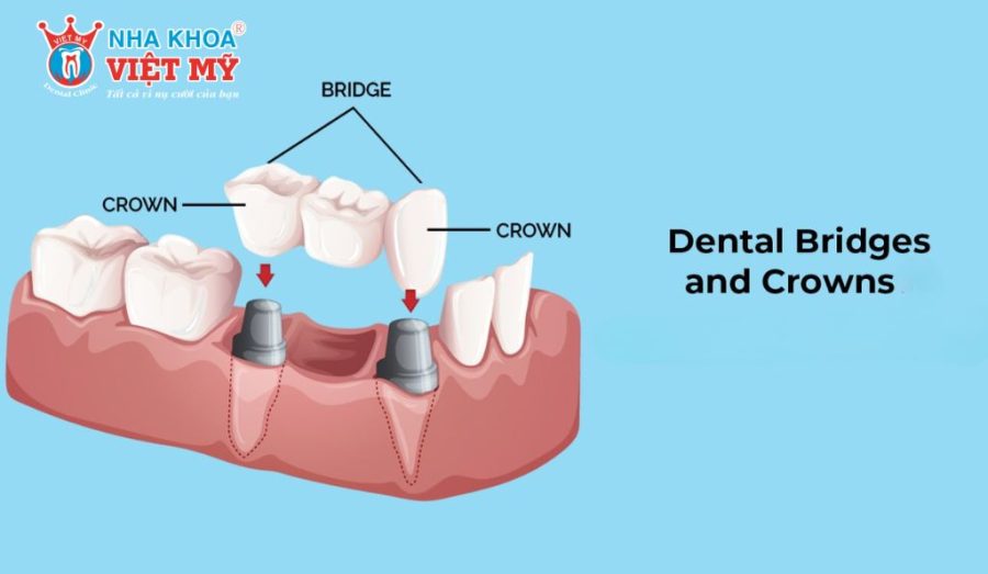 Dental crowns and bridges are durable restoration solutions