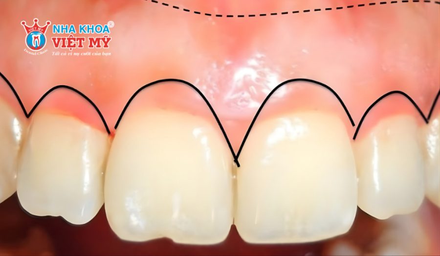 Ảnh hưởng của việc hô xương ổ răng