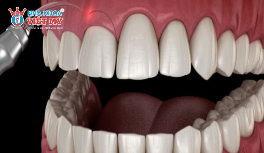 Một số phương pháp điều trị hô xương ổ răng hiệu quả hiện nay