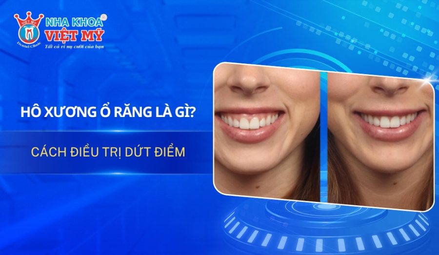 Hô xương ổ răng là gì? Cách điều trị dứt điểm