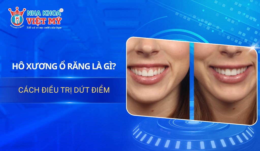 Hô xương ổ răng là gì? Cách điều trị dứt điểm