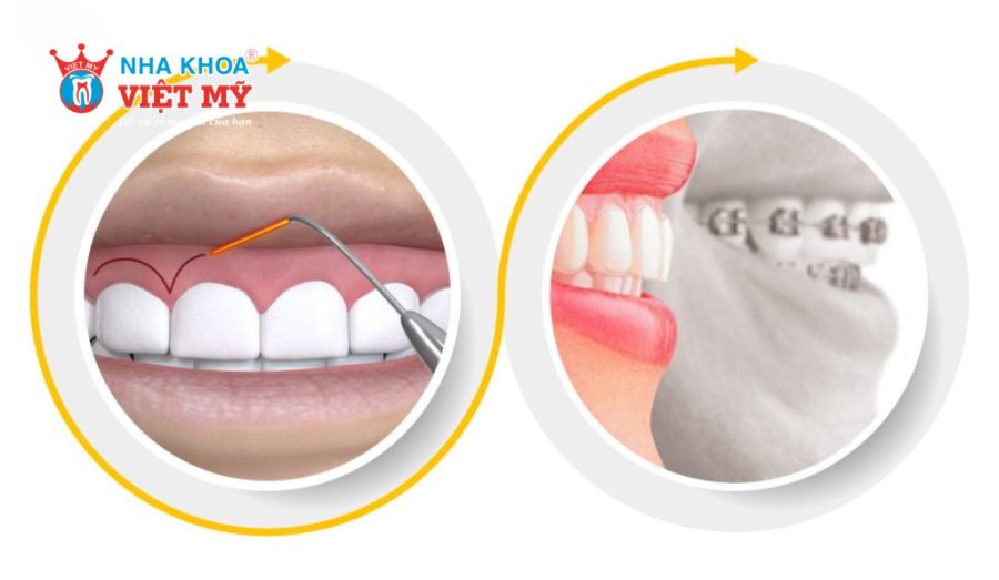 Nguyên nhân gây ra tình trạng hô xương ổ răng